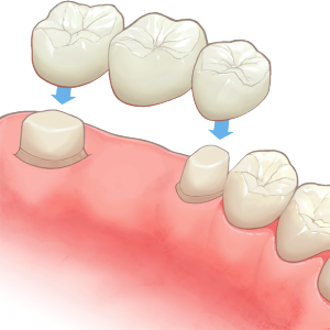 ブリッジ治療 | さいとう歯科医院｜ホワイトエッセンス加盟院