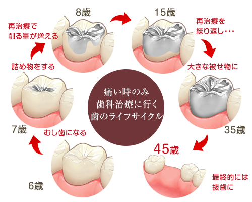 むし歯の治療 ホワイトエッセンス京急久里浜 さいとう歯科医院